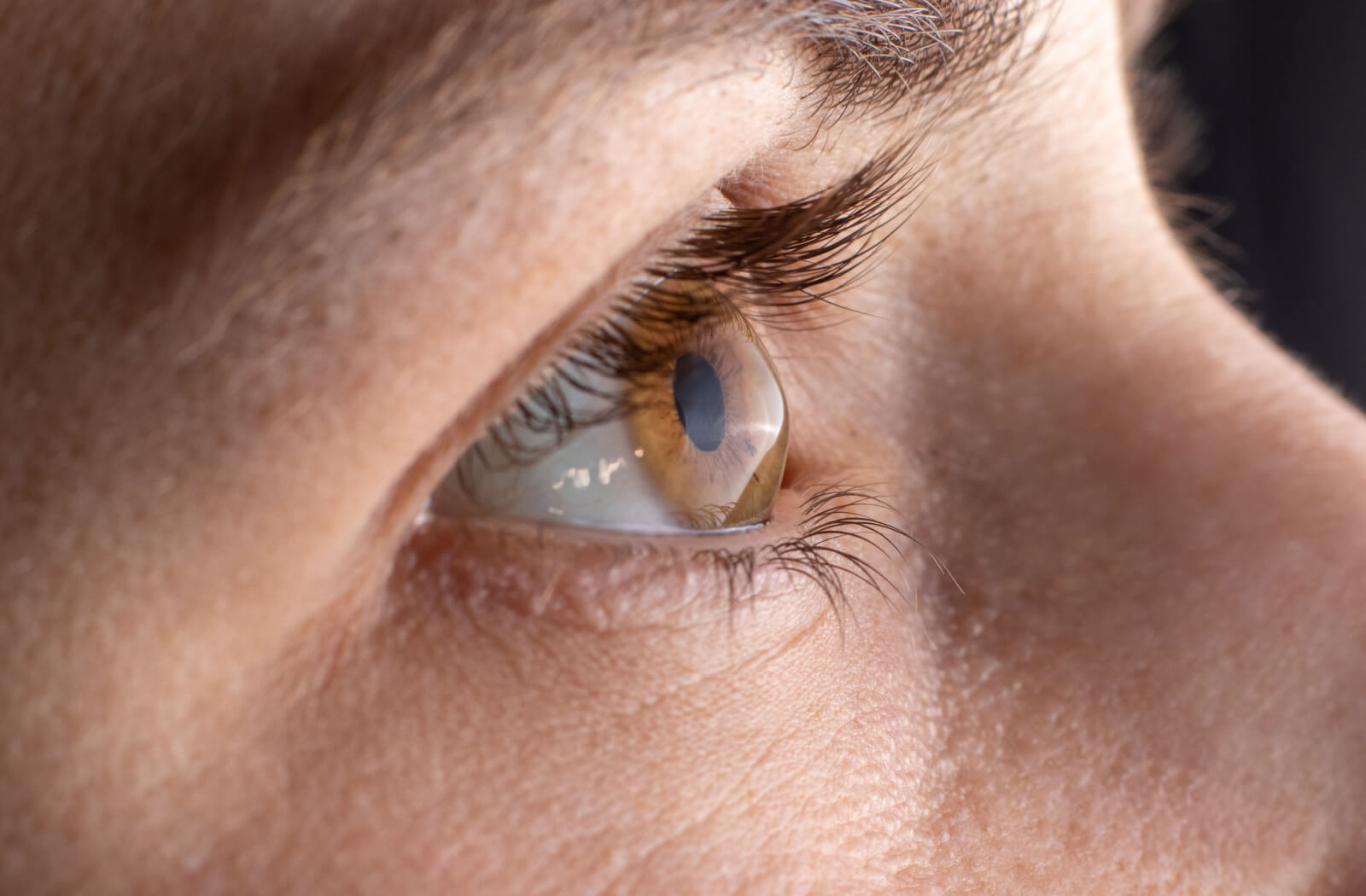 A close-up of an eye showing a cone shape cornea.