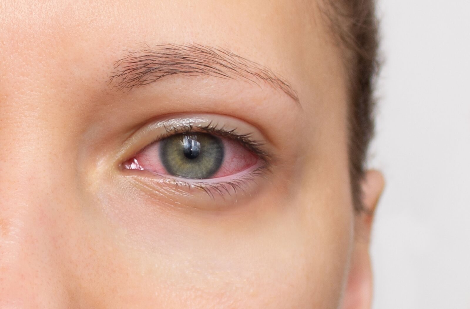 A close view of a woman's eye showing redness from dry eyes.